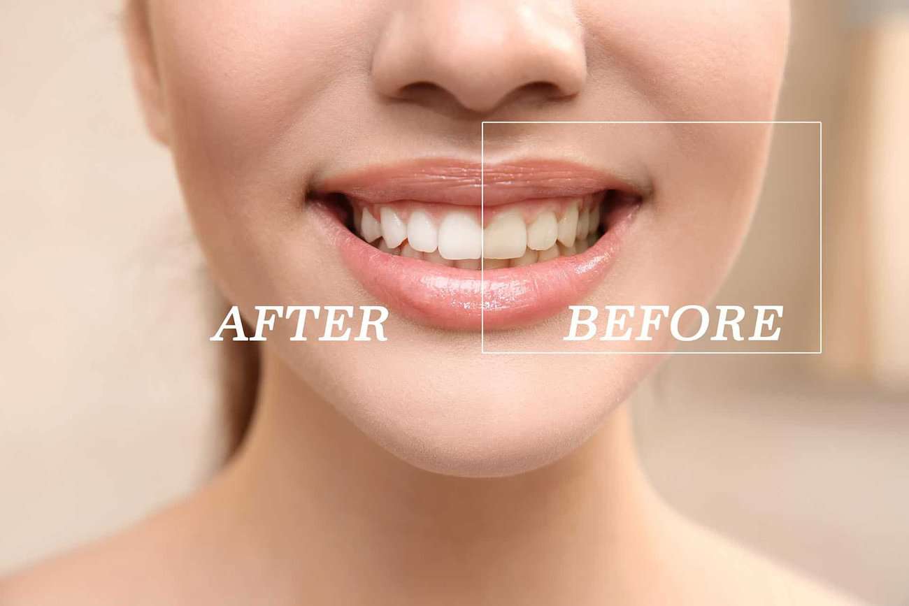 What Are the Most Effective Natural Teeth Whitening Methods You Can Try Lisburn?