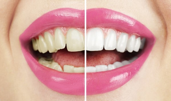 What Makes Ultima White Teeth Whitening Different Lisburn