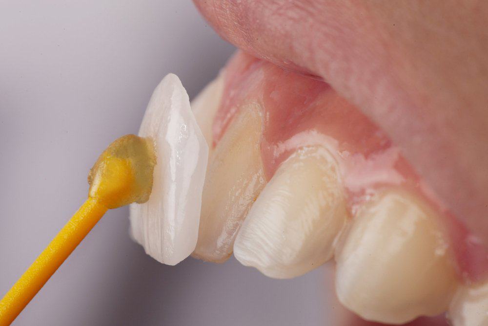 Why Do Dental Crowns Fail or Get Damaged Prematurely Lisburn?