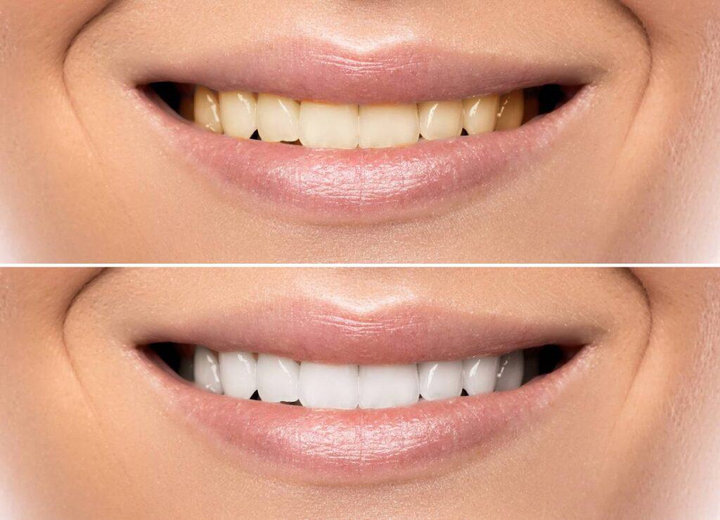 How Can You Protect Your White Smile as a Coffee Lover Lisburn?