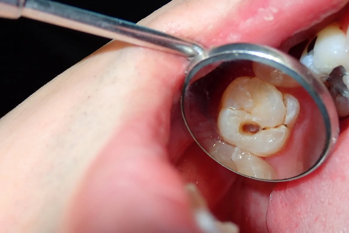 Why Do Teeth Crack? Common Causes to Know Lisburn