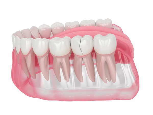 How Can You Manage Pain and Discomfort After a Root Canal Lisburn?