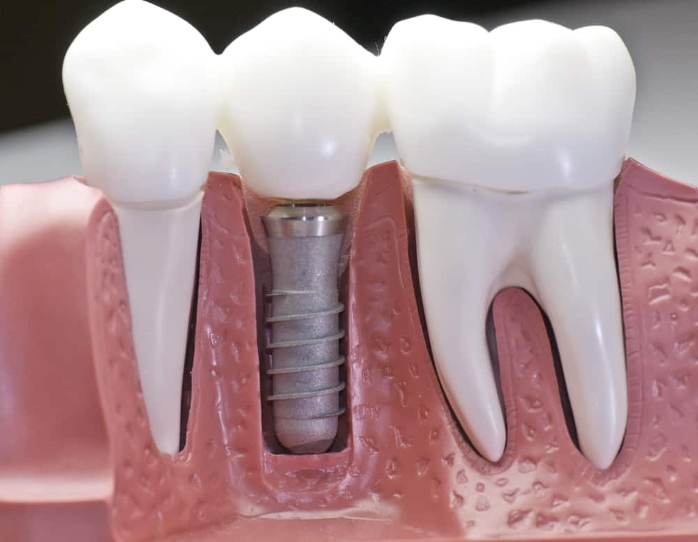 Common Misconceptions About Modern Dental Treatments Lisburn