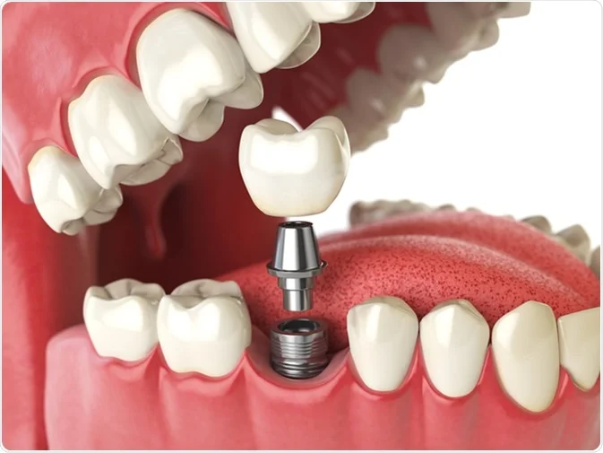 How Do I Decide Which Tooth Replacement Is Right for Me Lisburn?