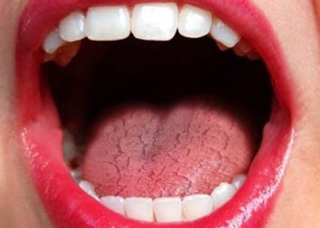 Common Causes of Dry Mouth (Xerostomia) Lisburn