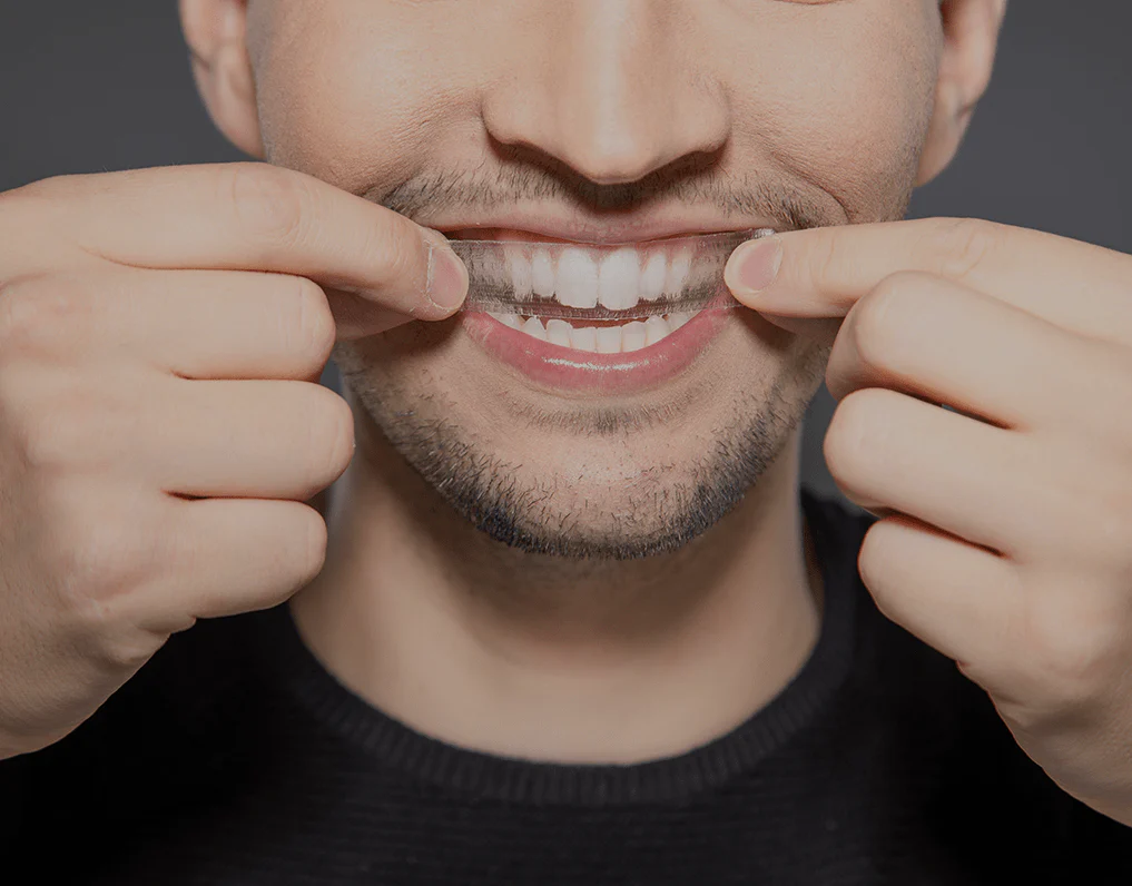 Can You Whiten Natural Teeth Without Harsh Chemicals Lisburn?