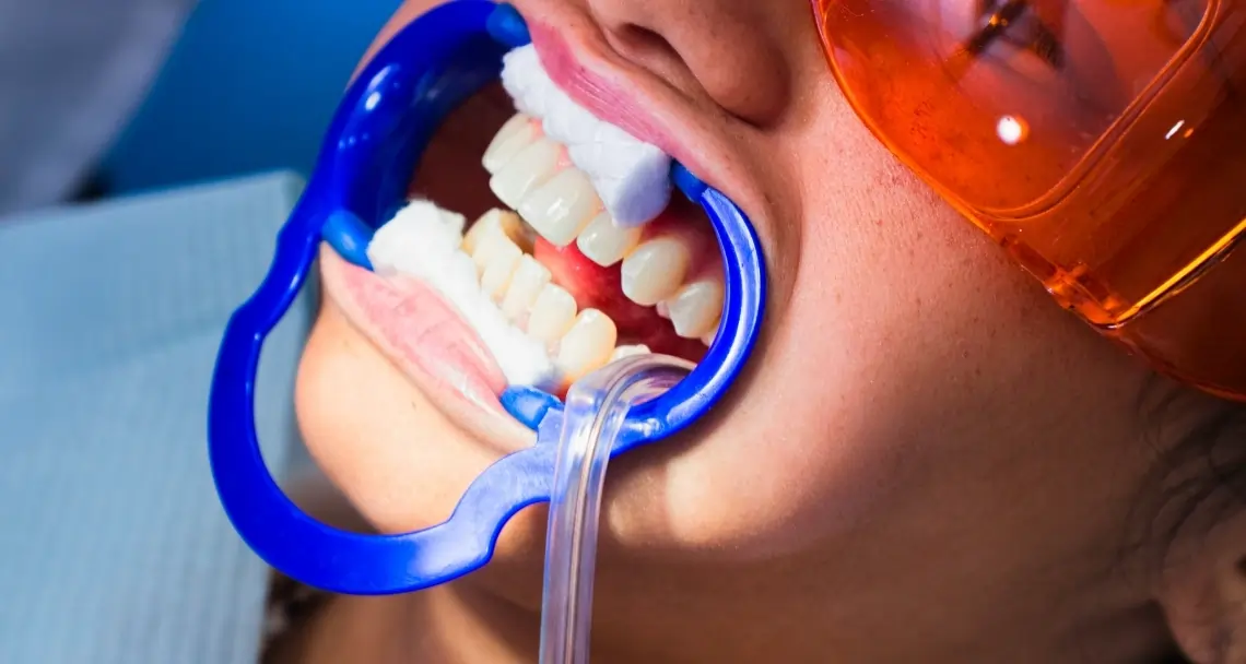 What Side Effects Can You Experience After Laser Teeth Whitening Lisburn?