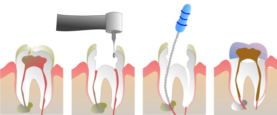 How Do You Properly Care for Your Teeth After a Root Canal Lisburn