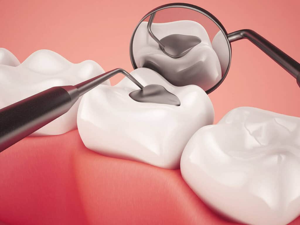Fighting Cavities and Plaque Buildup Lisburn