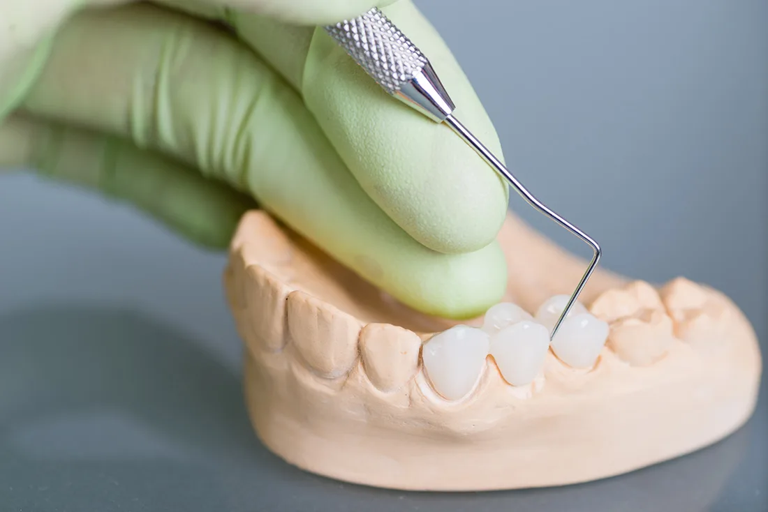 Do Braces Take Years to Show Results Lisburn
