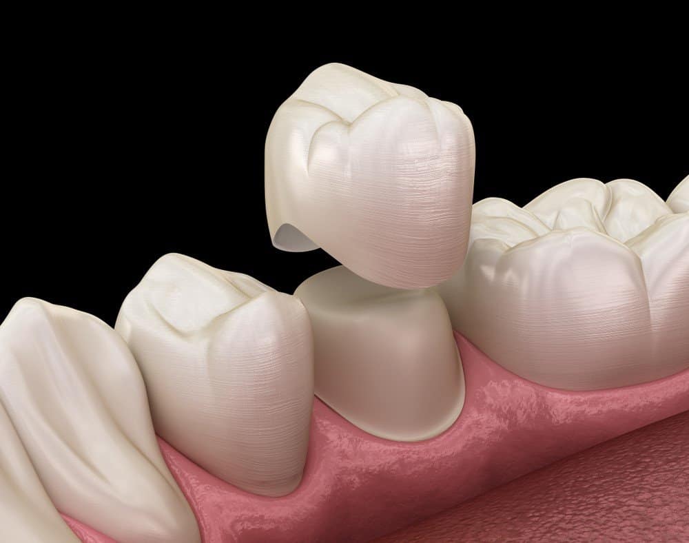 How Can You Prevent Common Dental Crown Problems Lisburn?