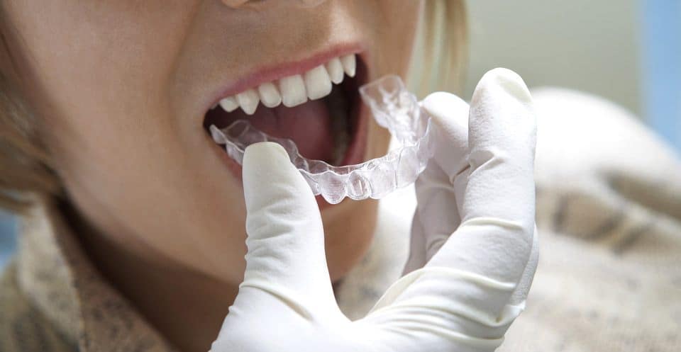 Why Bleaching Trays Require More Time Lisburn