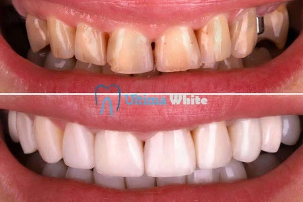 What Makes Instant Teeth Whitening Treatments So Popular Lisburn?