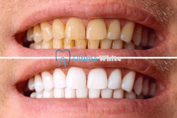 Stained Teeth and Persistent Bad Breath Lisburn